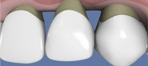 La rétraction des gencives après un traitement parodontal