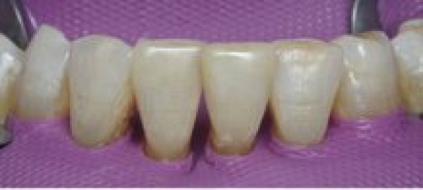 Cas clinique : Dentisterie Adhésive / Dentisterie Esthétique