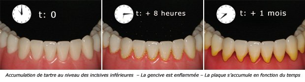 plaque-dentaire55